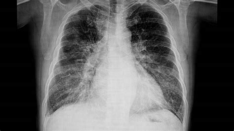 chest x-ray to diagnose asthma